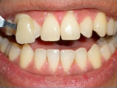 teeth whitening before image