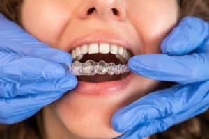 Suresmile teeth alignment