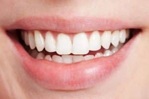 Teeth straightening with Suresmile