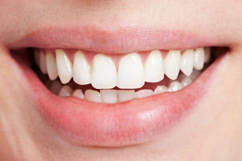 Teeth straightening with Suresmile