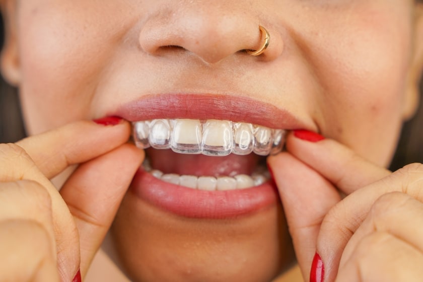 SureSmile teeth alignment