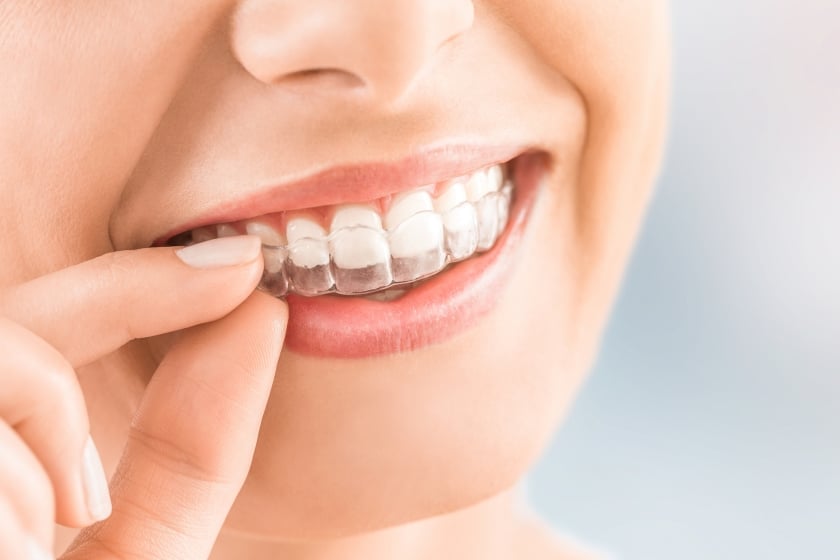 SureSmile teeth alignment